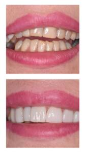 efekt leczenia bondingu - przed i po